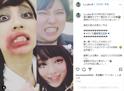 歯列矯正前のファーストサマーウイカ