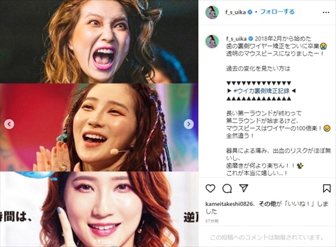 歯列矯正後のファーストサマーウイカ