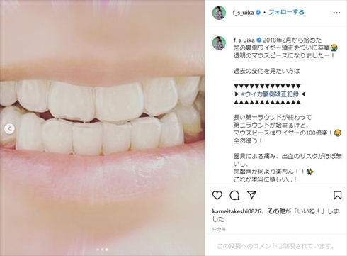 ファーストサマーウイカの歯並び