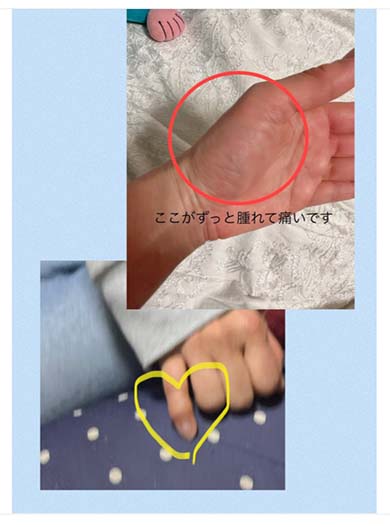 へバーデン結節と手根管症候群が判明した古村比呂