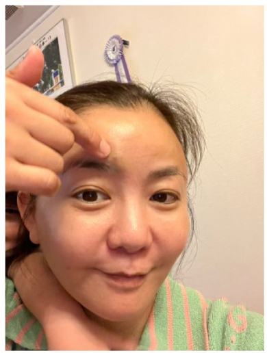 華原朋美のおでこのあざ