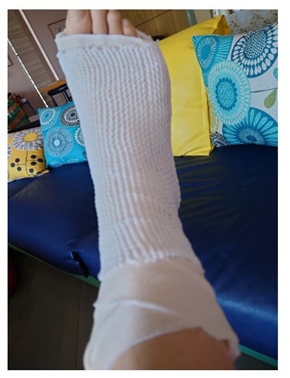 秋野暢子の骨折した足