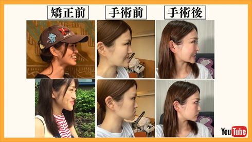 「顎変形症」の手術をした伊藤かりん
