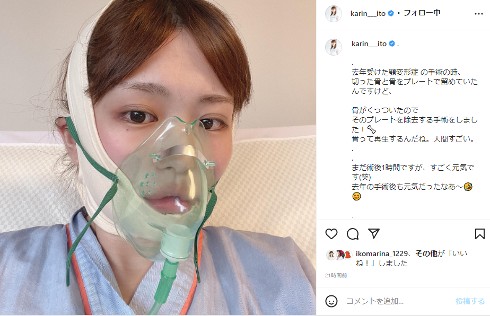 「顎変形症」手術で入れたプレートを抜いた伊藤かりん