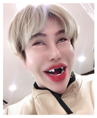 前歯を一度抜いた状態の整形男子アレン