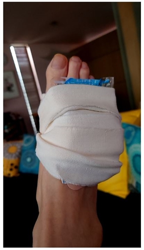 秋野暢子の骨折