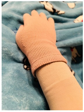 リンパ浮腫でグローブを付けただいたひかる