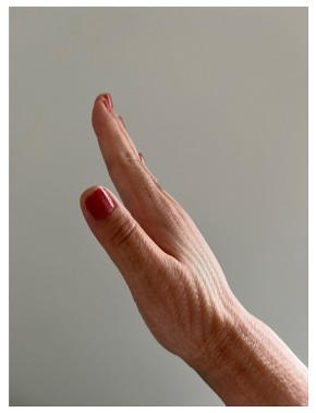 リンパ浮腫手術した手を公開するだいたひかる