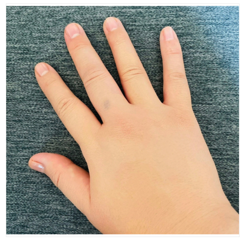 「リンパ浮腫」手術を受けただいたひかる