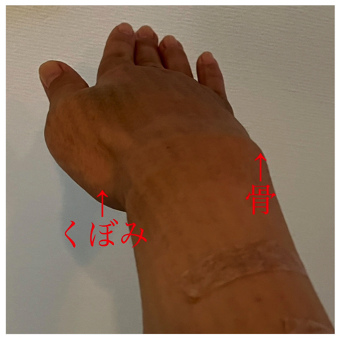 「リンパ浮腫」手術を受けただいたひかる