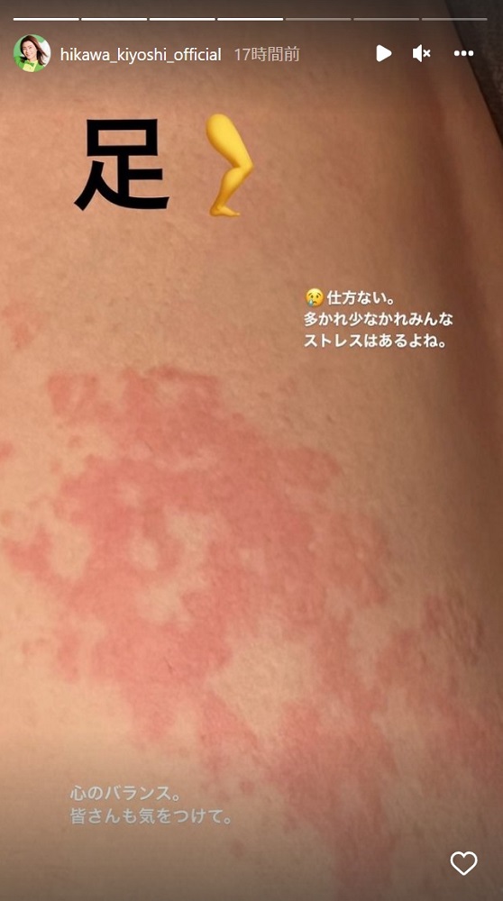 足に発疹ができた氷川きよし