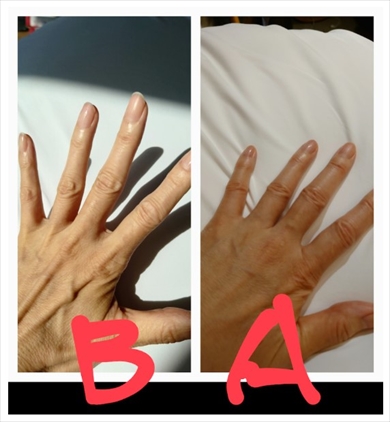 抗がん剤の副作用で手足が浮腫んだ秋野暢子