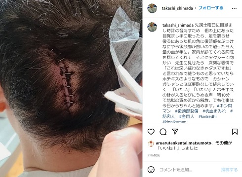 後頭部裂傷を負った「ゆでたまご」嶋田隆司