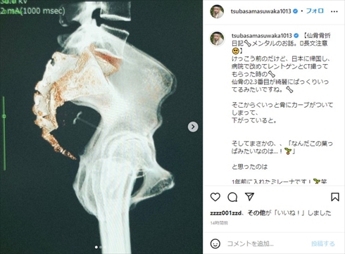 仙骨を骨折した益若つばさ
