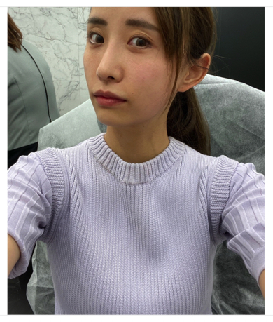 元SDN48の光上せあらが糸リフトで美容整形