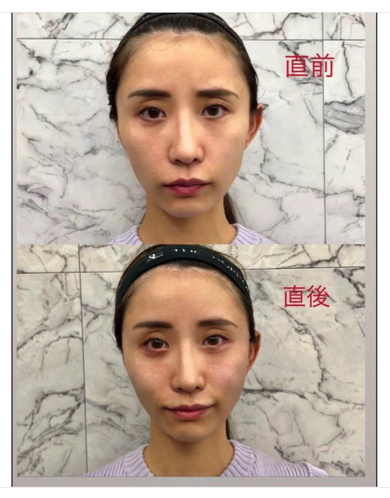 元SDN48の光上せあらが糸リフトで美容整形