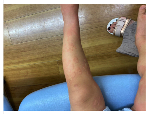 元SDN48の光上せあらの2歳となる娘が蕁麻疹で病院へ