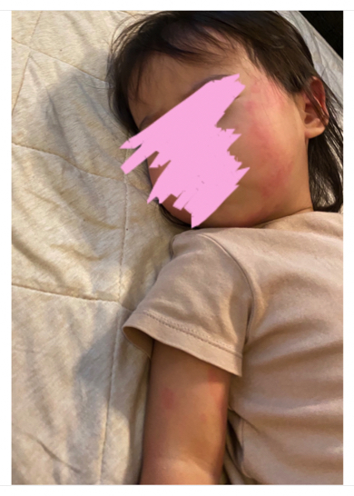 元SDN48の光上せあらの2歳となる娘が蕁麻疹で病院へ