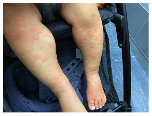 元SDN48の光上せあらの2歳となる娘が蕁麻疹で病院へ