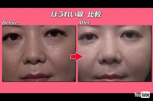  華原朋美の美容整形ビフォーアフター