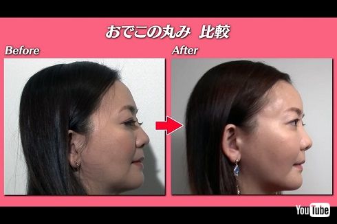  華原朋美の美容整形ビフォーアフター