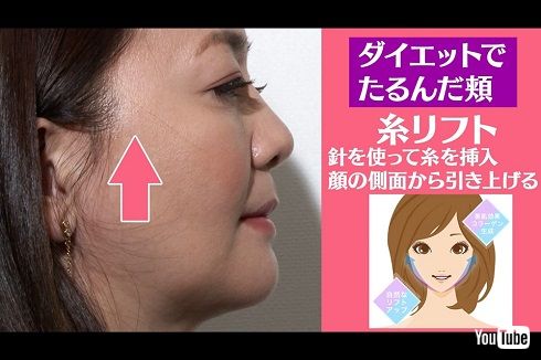 美容整形の説明を受ける華原朋美