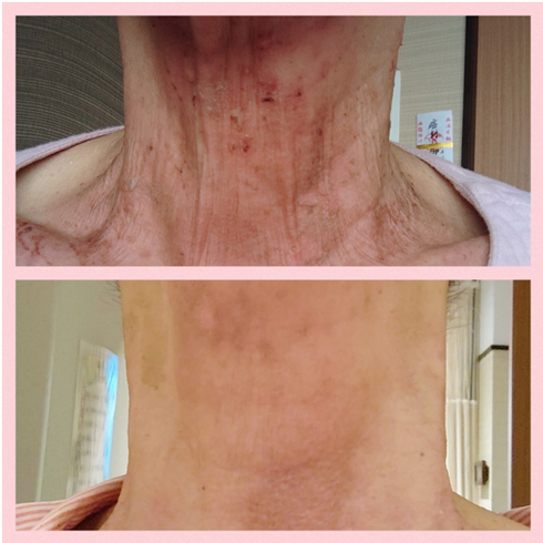 秋野暢子の抗がん剤治療ビフォーアフター