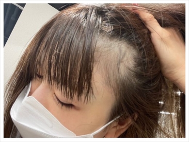 あいのり桃の産後の抜け毛