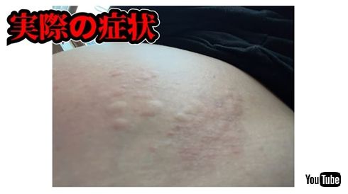 小森純の蕁麻疹