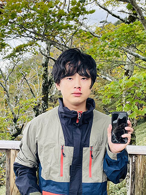 熊に襲われた人の写真・アップ