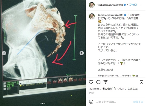 仙骨を骨折した益若つばさ