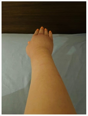 右腕がパンパンに浮腫んだだいたひかる