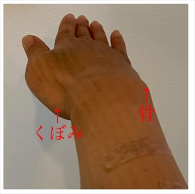 リンパ浮腫の手術を受けただいたひかる