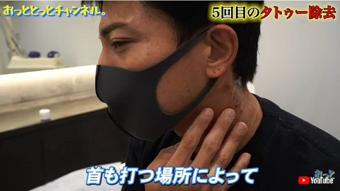 刺青除去施術後の後藤祐樹