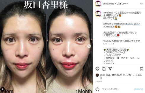 坂口杏里の整形ビフォーアフター