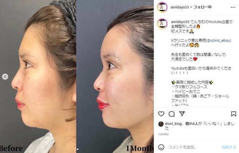 坂口杏里の整形ビフォーアフター