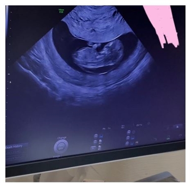 光上せあらのエコー写真