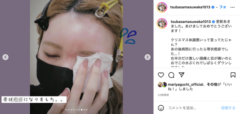 仙骨骨折で休業し重度の帯状疱疹と診断された益若つばさ