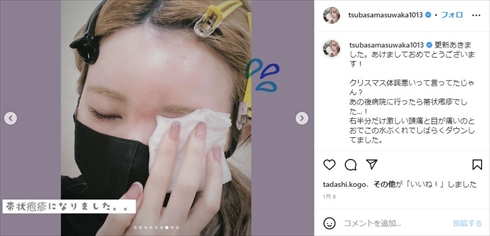 重度の帯状疱疹を患った益若つばさ