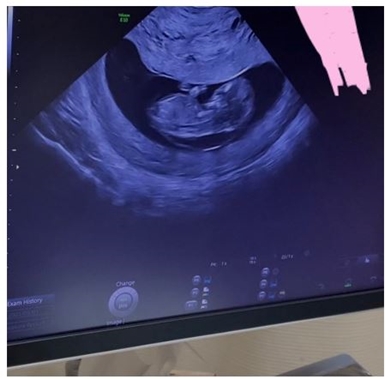 光上せあらのエコー写真