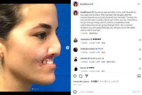 犬に噛まれ上唇失ったプロスケートボーダーが7回目の再建手術