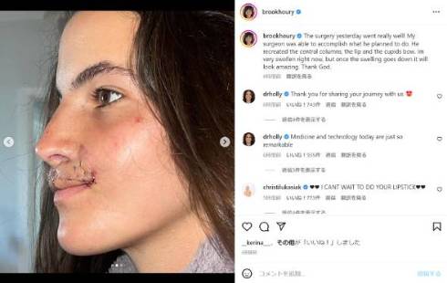 犬に噛まれ上唇失ったプロスケートボーダーが7回目の再建手術