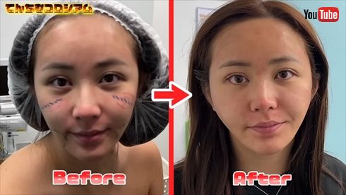 美容整形を受けたてんちむ