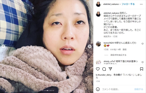 重度の眼瞼下垂を告白した「日本エレキテル連合」の中野聡子