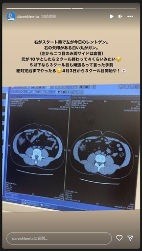 BEP療法、抗がん剤治療の効果を公開したダルビッシュ賢太