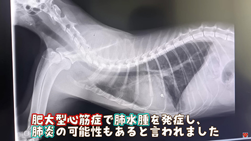 肥大型心筋症