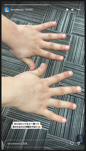 精巣がんで闘病しているダルビッシュ賢太