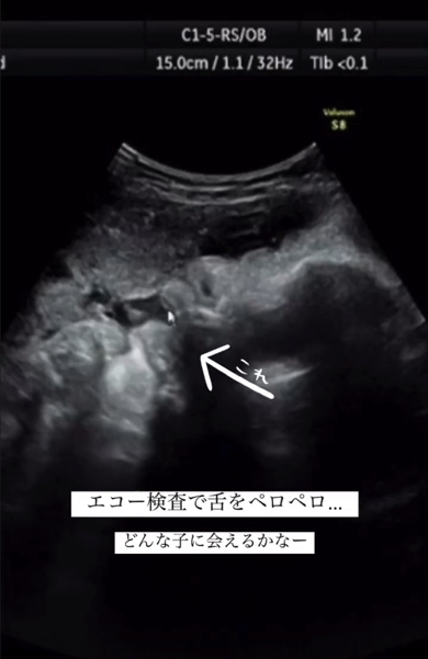 おなかの中で見せたクセを出産後にもしていた赤ちゃん