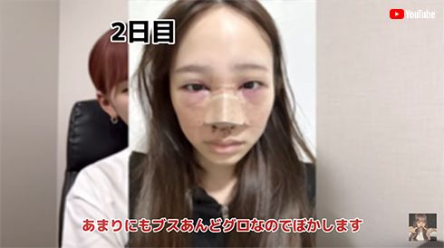 鼻の整形を報告した重川茉弥
