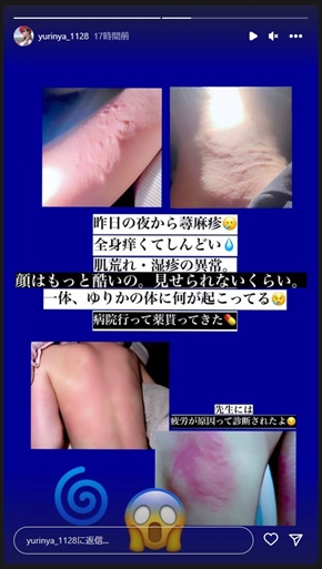 全身がひどく肌荒れした人気TikTokerのゆりにゃ